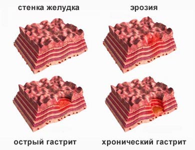 повреждение стенок желудка