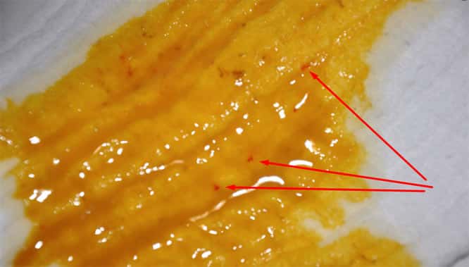 вкрапления крови в кале Вкрапления крови в кале