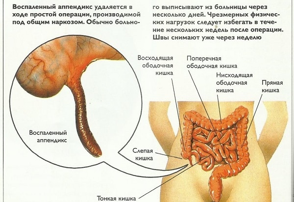 Гнойный аппендицит