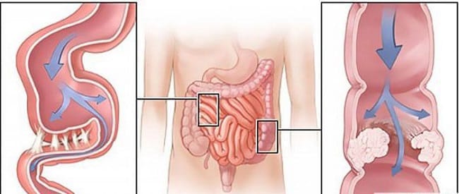 Кишечная колика