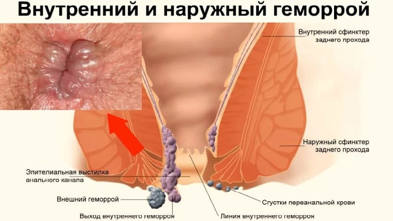 Чем опасен геморрой для женщин: основные признаки и методы лечения