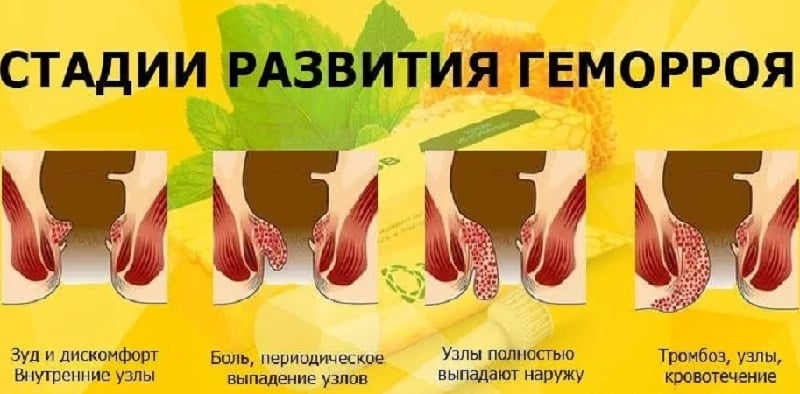 Чем опасен геморрой для женщин: основные признаки и методы лечения