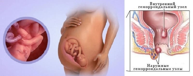 Чем опасен геморрой для женщин: основные признаки и методы лечения