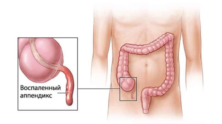 С какой стороны аппендицит: где находится у человека, в каком боку ...