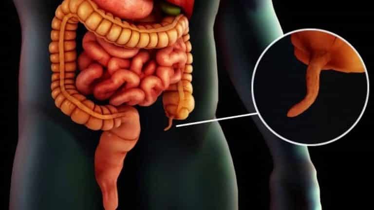 С какой стороны аппендицит: где находится у человека, в каком боку ...